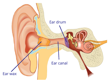 Diagram showing how ear wax blocks the ear canal.