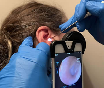 Ear wax removal using a camera and a suction tube (cannula).